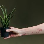 Psoriazisul: cum se manifestă și ce opțiuni de tratament există